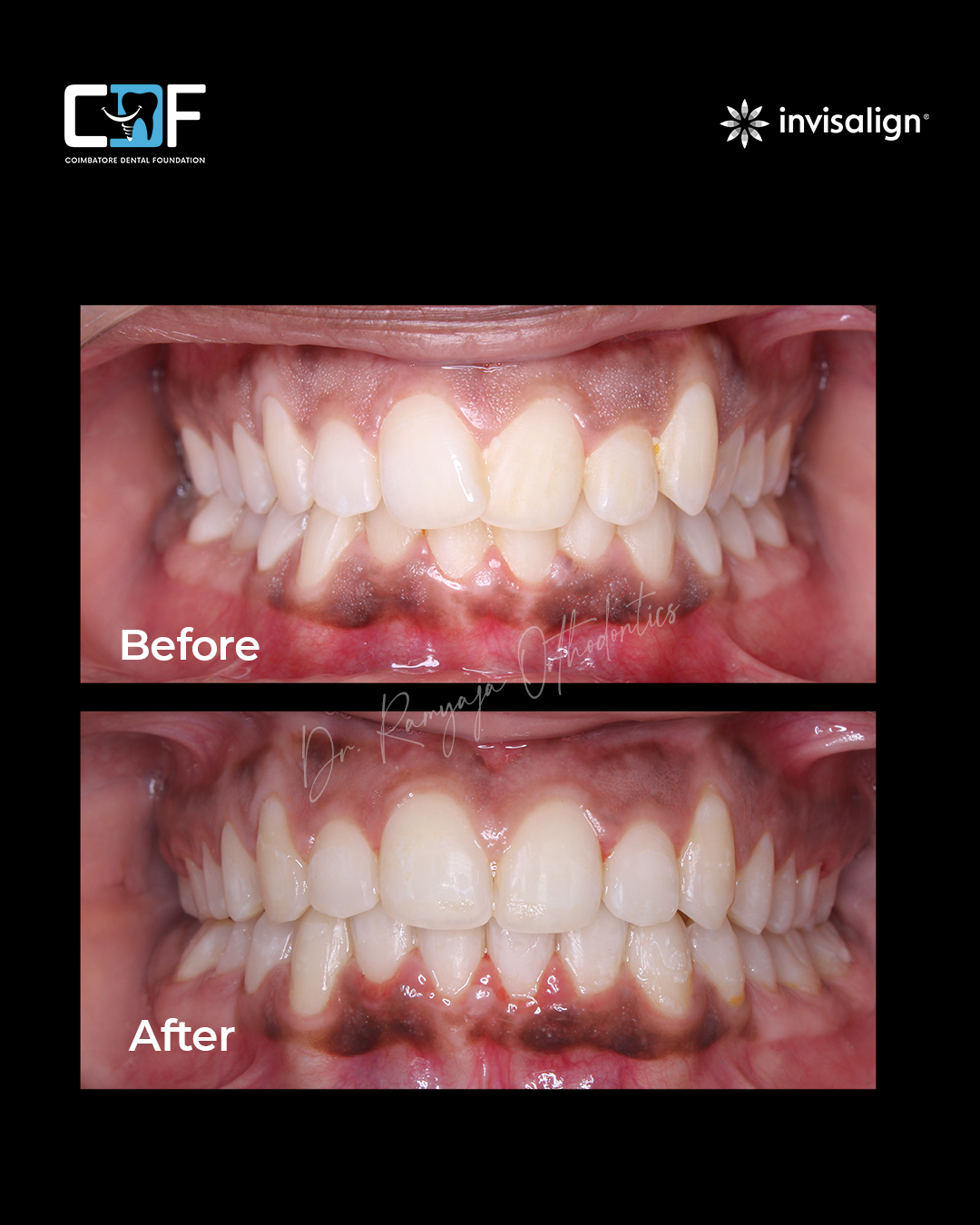 Before After Result